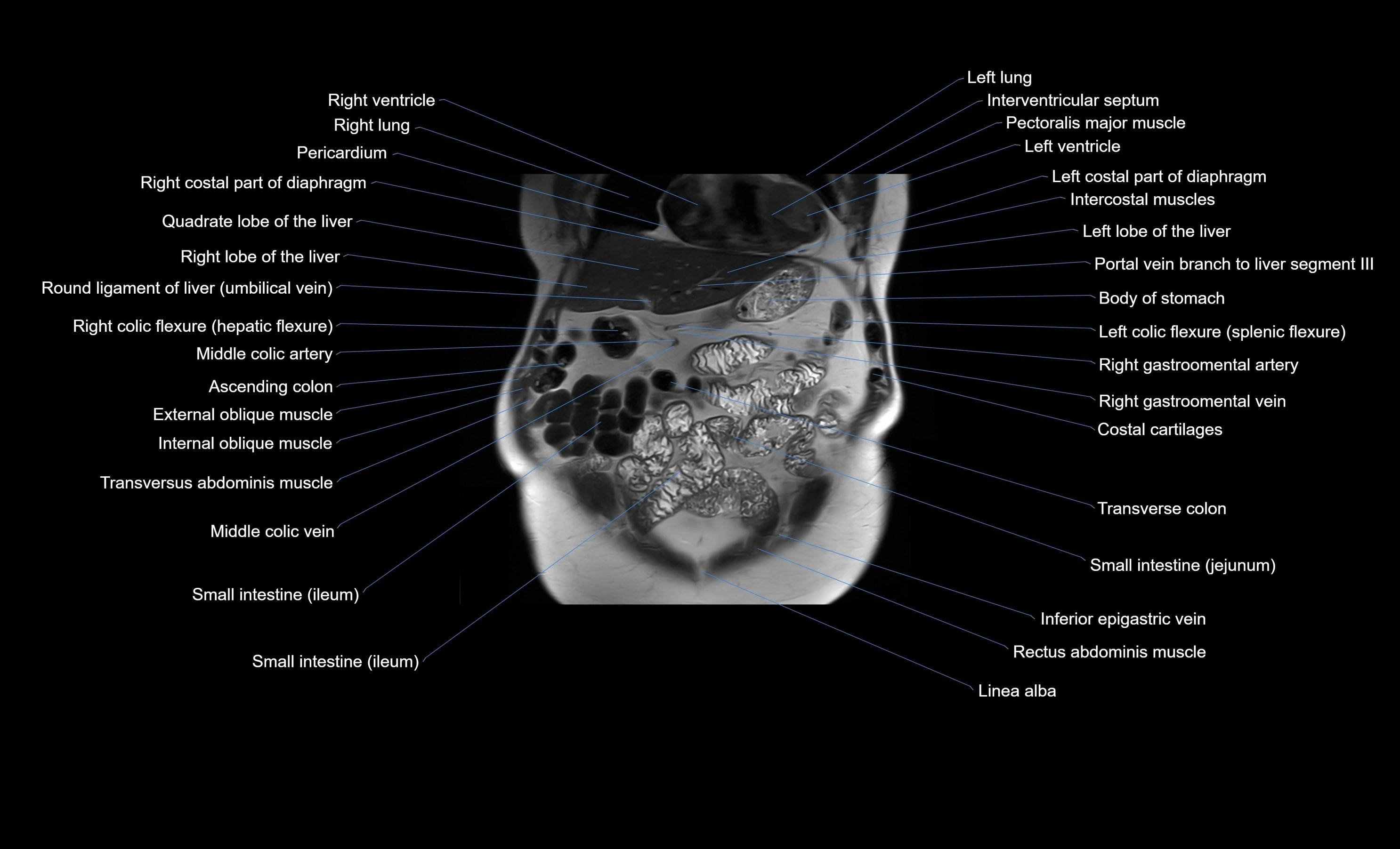MRI Abdomen coronal labelled cross sectional anatomy radiology  image-img-00001-00015.webp